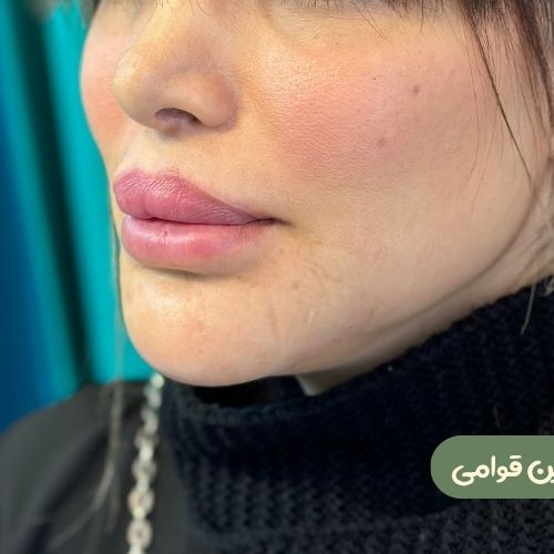 بعد از ژنیوپلاستی