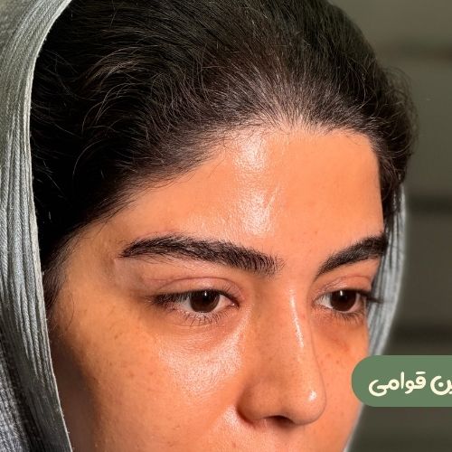 بعد از دایرکت ابرو