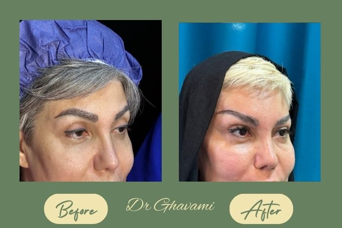 لیفت شقیقه