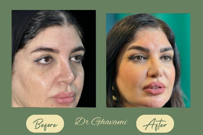 لیفت شقیقه