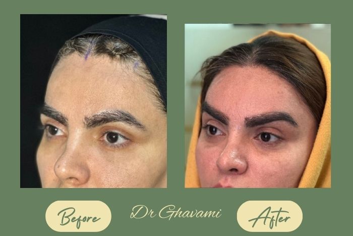 لیفت شقیقه