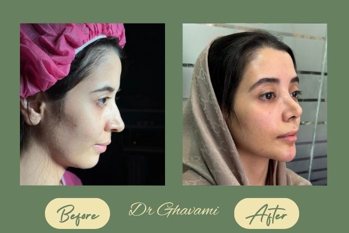 رینوپلاستی