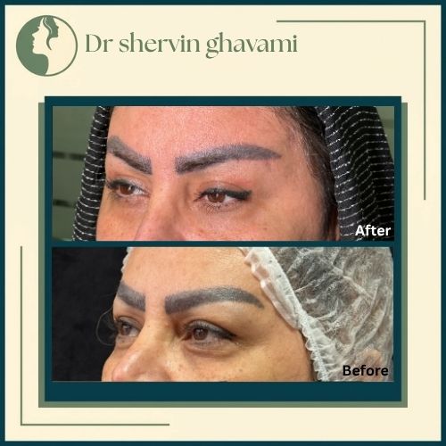 بلفاروپلاستی و دایرکت ابرو و لیفت شقیقه