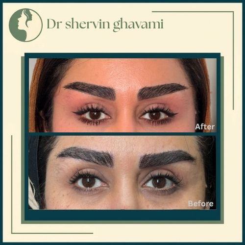 لیفت شقیقه