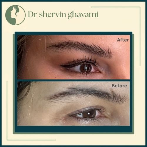 لیفت شقیقه