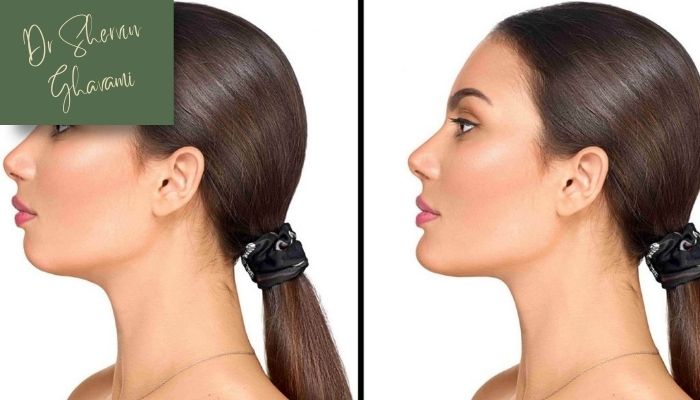 اهمیت مراقبت‌های پس از کاشت چانه و گونه