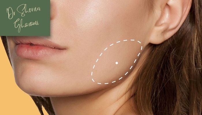 بوکال فت چه تغییری در صورت ایجاد می‌کند؟