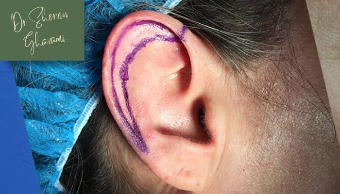 دلایل انجام جراحی زیبایی گوش دلایل انجام جراحی زیبایی گوش