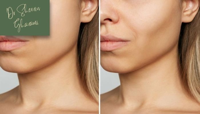 دلایل شل‌شدن پوست بعد از جراحی گونه 