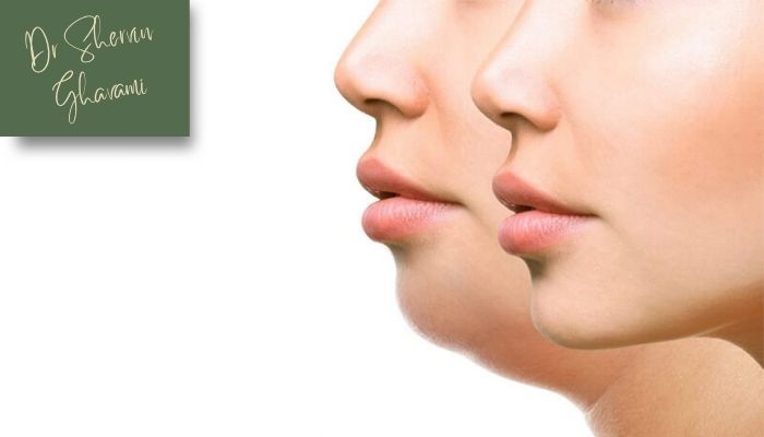 دلایل مشخص شدن منتوپلاستی از زیر پوست