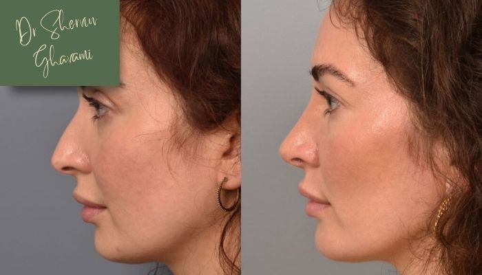 نقش سن در افتادگی پوست پس از جراحی صورت 